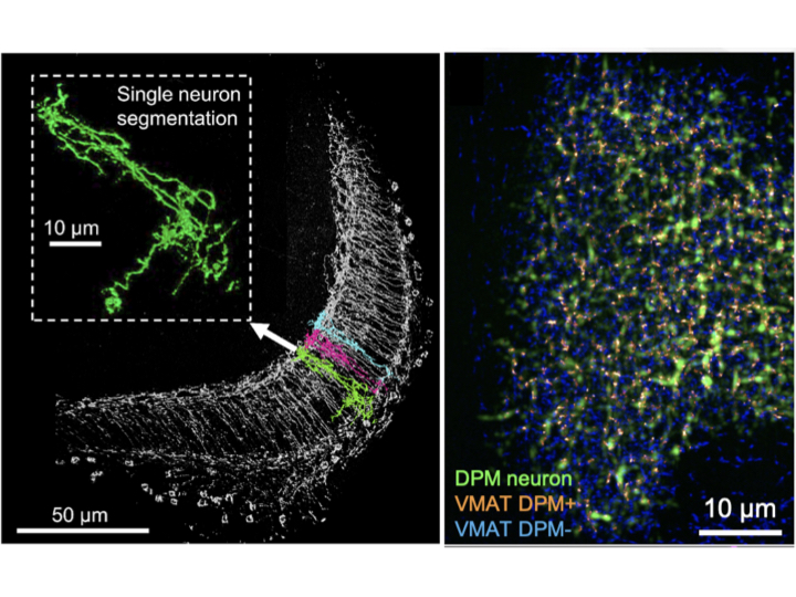 Left: Single dopaminergic neuron located in fly eye can be manually segmented. Right: VMAT distribution in whole DPM neuron can be located.